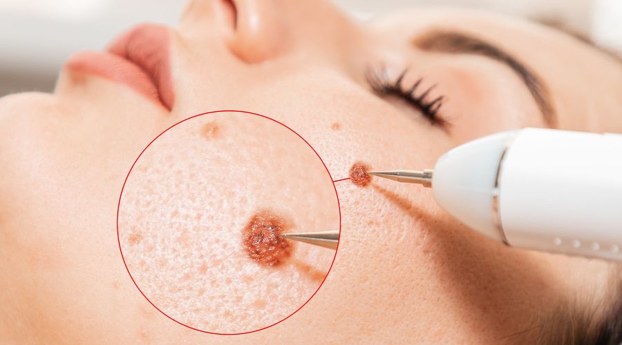 Melanom dışı cilt kanseri melanomdan daha yaygın